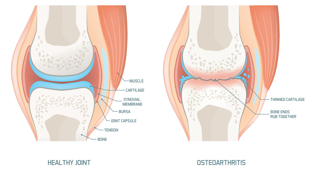Osteoarthritis Treatment Monmouth County NJ