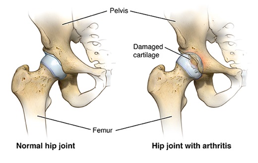 Hip Surgery Neptune NJ